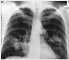 This is an x-ray image of a chest. Both sides of the lungs are visible with a growth on the left side of the lung, which could possibly be lung cancer.