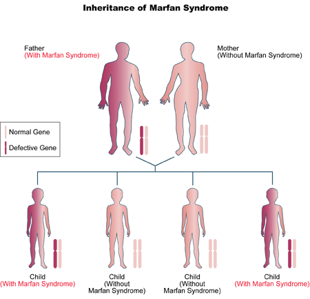 Inheritance of Marfan Syndrome