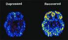 PET scans showing the effects of treatment on depression. - Click to enlarge in new window.