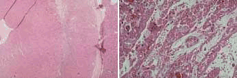 Microscopic sections of heart tissue from a rat-to-rat heart allotransplant (left) and a hamster to-rat heart xenotransplant (right). Examined 60 days after the transplant, the rat heart is healthy, while the hamster heart shows extensive damage. Courtesy