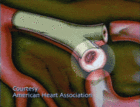 Illustration of a clot blocking an artery. - Click to enlarge in new window.