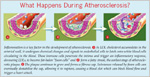 Diagram of what happens during atherosclerosis