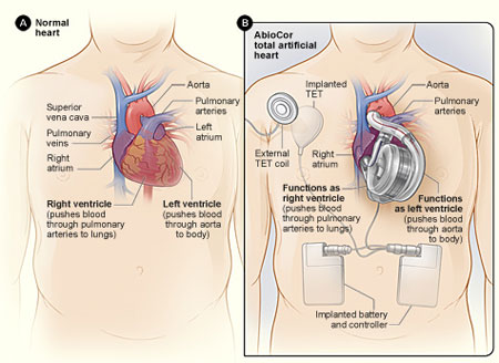 Figure A shows the normal anatomy and location of the heart. Figure B shows an AbioCor TAH and the internal devices that control how it works.