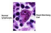 Reed-Sternberg cell; photograph shows normal lymphocytes compared with a Reed-Sternberg cell.