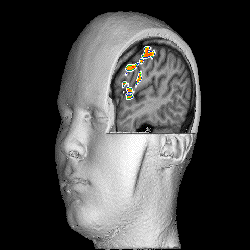 The subject was told to move his finger; his brain orchestrates the process. The picture here shows the regions of the brain that are participating in the process. Image courtesy of Dr. Peter Jezzard of the National Heart, Lung, and Blood Institute, NIH.