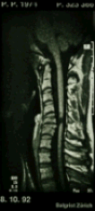  magnetic resonance image (MRI) of the cervical spinal cord of a paraplegic patient showing a cavern (dark area) that has formed at the site of injury. The spinal cord is crushed, not severed, as seen by the continuity of the white matter.
