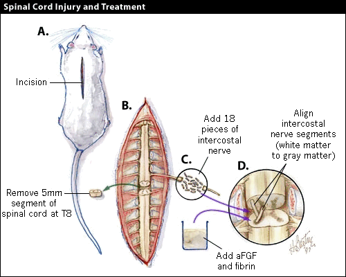 Diagram of spinal cord injury and treatment