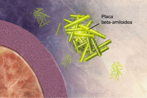 Los fragmentos beta-amiloideos empiezan a unirse en masas
