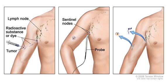 Sentinel lymph node biopsy of the skin. Three-panel illustration showing a radioactive substance and/or blue dye is injected near the tumor (first panel), the injected material is detected visually and/or with a probe (middle panel), and the sentinel nodes (the first lymph nodes to take up the material) are removed and checked for cancer cells (last panel).