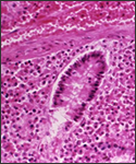 This micrograph reveals submucosal hemorrhage in the small intestine, in a case of fatal human anthrax; H&E stain; Mg. 240X.