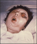 This female patient is shown here on the 5th day of a Bacillus anthracis infection involving her left eye.