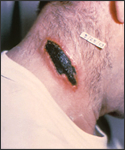 Anthrax lesion on the neck.