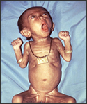 This image depicts a female infant who presented to a clinic suffering from what was diagnosed as pertussis.