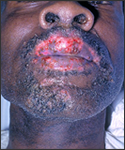 Herpes Simplex lesions on the skin of the face of a patient with pneumococcal meningitis.