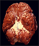 This ventral view of a human brain depicts a purulent basilar meningitis infection due to Streptococcus pneumoniae bacteria.