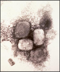 This electron micrograph depicts the variola, smallpox virus using a negative stain technique; Magnification 65,000X.