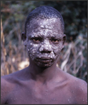 This 1969 photograph depicted a Dekina, Nigerian male smallpox sufferer, and revealed the maculopapular rash dispersed over the victim’s face, which displayed numerous coalescent lesions; lesions were also visible on this patient’s arms and chest.