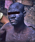 This photograph, taken in Dekina, Nigeria, showed a smallpox patient with many lesions on his face; this disease usually spares the chest and back.