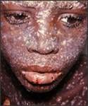 A severe case of smallpox lesions on the face of patient living in Accra, Ghana, 1967.