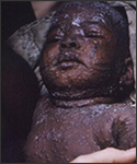 This photograph, taken in Dekina, Nigeria, showed a sleeping child who had presented with smallpox lesions over most of the child’s body.