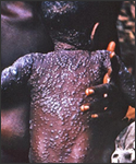 This photograph reveals the back of a Nigerian child with smallpox. Note the pustules are centripetal in distribution, radiating from their densest area of eruption on the upper back, and outwards along the extremities. All the skin lesions are at the same stage of development.