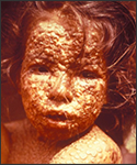 This young girl in Bangladesh was infected with smallpox in 1973.