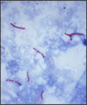 This photomicrograph reveals Mycobacterium tuberculosis bacteria using acid-fast Ziehl-Neelsen stain; Magnified 1000X.
