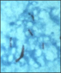 This photomicrograph reveals Mycobacterium tuberculosis bacteria using acid-fast Ziehl-Neelsen stain; Magnified 1000X.
