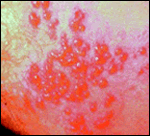 shingles image