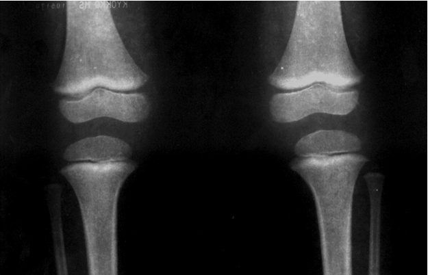 Radiografías de huesos largos en las rodillas. Líneas de plomo presentes en una niña de 3 años y 2 meses