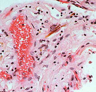 Asbestos fibers lodged in the lungs