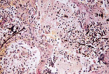 Microscopic view of lung tissue with asbestosis