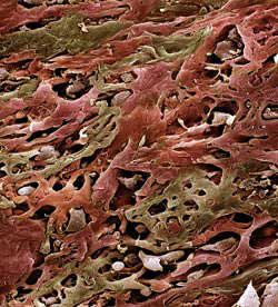 Scanning Electron Micrograph of Lung Cancer Cells