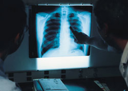 Chest X-Rays are the most common method of detecting asbestos-related disorders
