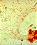 Cerebrospinal fluid culture positive for Haemophilus influenzae, type b (Gram stain).