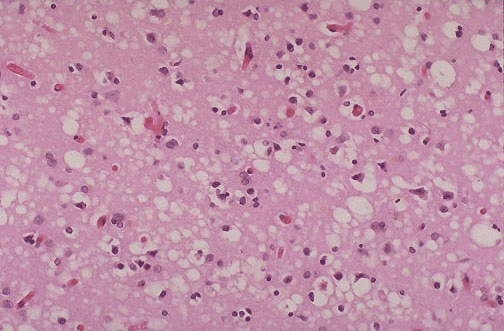 This tissue slide shows sponge-like lesions in the brain tissue of a classic CJD patient.