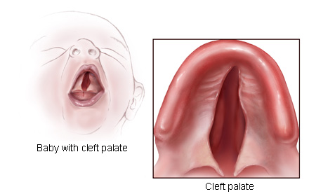 Baby with cleft palate and view from inside mouth
