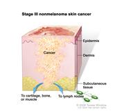 Stage III nonmelanoma skin cancer; drawing shows a tumor that has spread from the epidermis (outer layer of the skin) and dermis (inner layer of the skin) into the subcutaneous tissue and to cartilage, bone, or muscle below the skin and/or to nearby lymph nodes.