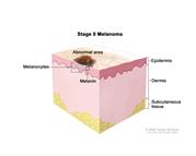 Stage 0 melanoma; drawing shows skin anatomy with an abnormal area on the surface of the skin. Both normal and abnormal melanocytes and melanin are shown in the epidermis (outer layer of the skin). Also shown are the dermis (inner layer of the skin) and the subcutaneous tissue below the dermis.