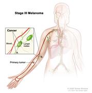 Stage III melanoma; drawing shows a primary tumor on the lower arm. Cancer is also shown in lymph nodes in the armpit region. The pullout shows cancer in a lymph node and lymph vessels in the arm near the tumors.