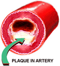 illustration of artery clogged with plaque