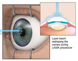 (Image from animation, showing laser beam reshaping the cornea during LASIK procedure.)