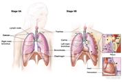 Two-panel drawing of stage II non-small cell lung cancer; first panel shows stage IIA with cancer in one lung and cancer in several nearby lymph nodes on the same side of the chest; the right main bronchus is also shown; second panel shows stage IIB with cancer in the chest wall, the diaphragm, the pleura between the lungs, and in the left main bronchus; the trachea, carina, and bronchioles are also shown; One inset shows a close up of cancer spreading from the lung into the pleura and chest wall; another inset shows a close up of cancer spreading from the lung into the pericardium (membrane around the heart).