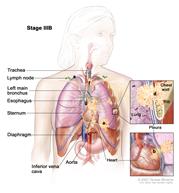 Stage IIIB non-small cell lung cancer; drawing shows cancer in the lymph nodes above the collarbone or lymph nodes in the opposite side of the chest from the cancer; also shows cancer in the trachea, left main bronchus, esophagus, sternum, diaphragm, inferior vena cava, aorta, heart, and chest wall. One inset shows a close-up of cancer spreading from the lung into the pleura and chest wall; another inset shows a close-up of cancer spreading from the lung into the pericardium (membrane around the heart) and the heart.