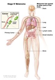 Stage IV melanoma; drawing shows that the primary tumor has spread to other parts of the body, such as the brain, lung, liver, lymph nodes, small intestine, or bone. The pullout shows cancer in the lymph nodes, lymph vessels, and blood vessel.