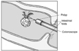 Drawing of a polyp being removed by a colonoscope.