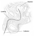 Drawing of the male urinary tract with a catheter placed through the urethra to the bladder. Labels identify the catheter, urethra, and bladder.