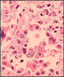 Histopathology of measles pneumonia, (Giant cell with intracytoplasmic inclusions.) 