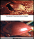 image of Epicardial Petechial Hemorrhages and Necrotic Foci