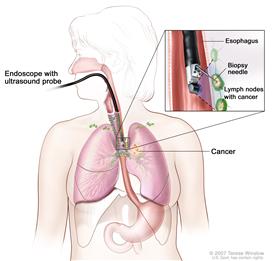 Endoscopic ultrasound-guided fine-needle aspiration biopsy; drawing shows an endoscope with an ultrasound probe and biopsy needle inserted through the mouth and into the esophagus. Drawing also shows lymph nodes near the esophagus and cancer in one lung. Inset shows the ultrasound probe locating the lymph nodes with cancer and the biopsy needle removing tissue from one of the lymph nodes near the esophagus.